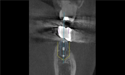 術前CT奥の歯
